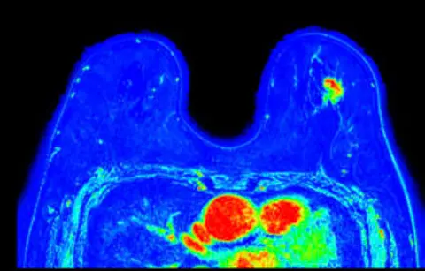 Episode 32: Breast MRI