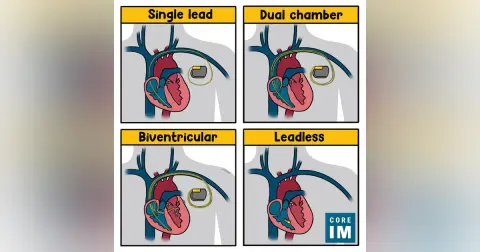#123 Pacemakers & ICDs: 5 Pearls Segment