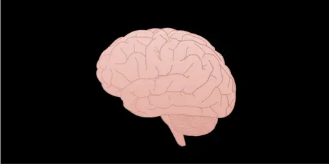 Intracranial Aneurysms