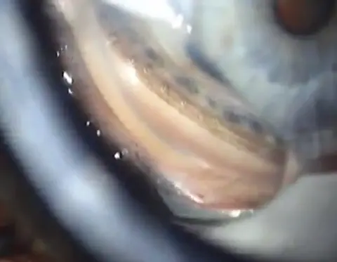 Ep 20 Talking About Glaucoma - 3Jan2013: Excimer Laser Trabeculostomy (mp3 version)