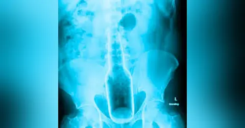 What was the most Embarrassing thing you've had to go to the ER for?