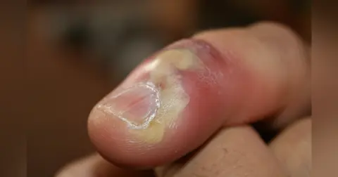 Herpetic Whitlow Infection