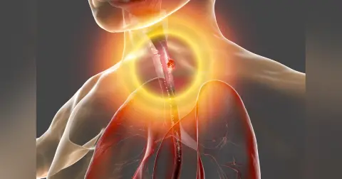 Management of Esophageal Cancer