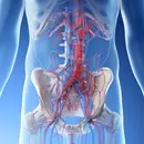Acute Mesenteric Ischemia