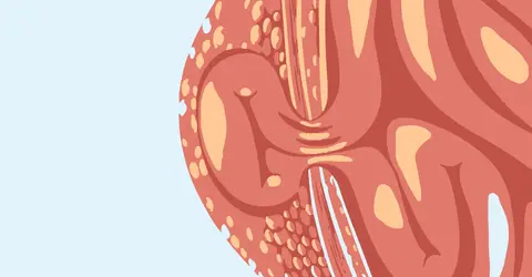 Lumbar Hernias