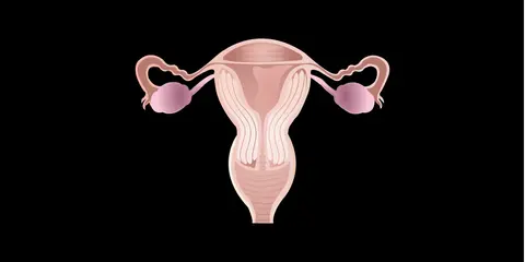 Ovarian Cancer