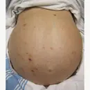 CORE IM podcast: Mind The Gap on Admission Paracentesis