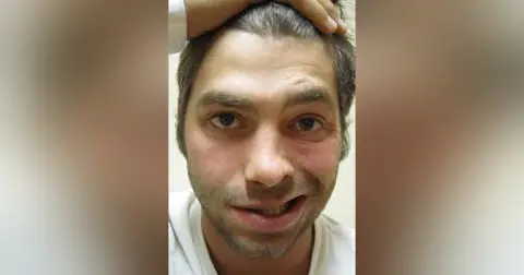 Facial Nerve Palsy Part 1