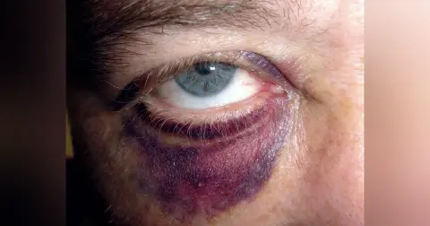 Orbital Fracture