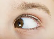 Strabismus
