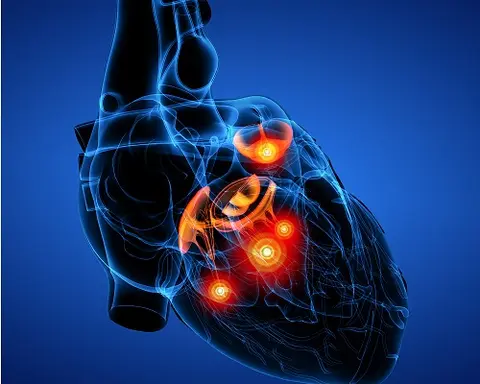Valvular Emergencies